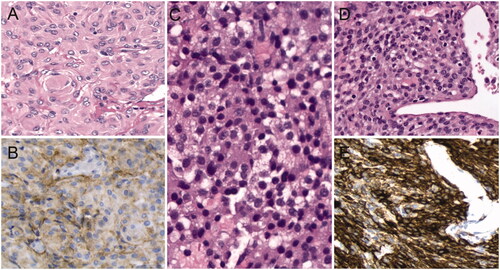 Figure 2. Histological examination reveals a meningioma (A) with positive staining for Epithelial Membrane Antigen (B), a pituitary adenoma (C), and a glomangiopericytoma (D) with positive staining for SMA (E).