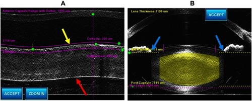 Figure 1 Images from a circle scan (A) and a line scan (B) in the normal eye. In the normal eye, the anterior capsule (yellow arrow) and posterior capsule (red arrow) were parallel in the line scan. There was no abnormal space between the iris and lens in the line scan (blue arrow).