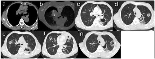 Figure 2. (a) A chest CT image showing a primary tumor 4.5 cm in diameter abutting the thoracic aorta and left lower pulmonary artery in the superior segment of the left lower lobe. (b) Despite a mild pneumothorax, MWA was successfully completed with a power of 70 W for a total of 21 min. (c) A CT scan 3 weeks after MWA showing a thin-walled cavity with an irregular luminal surface in the ablation zone. (d) The same CT scan 3 weeks after MWA showing coexistence of the cavity and nodules with a halo sign in the left upper lobe. (e) The same CT scan 3 weeks after MWA showing consolidation with cavitation in the right upper lobe and an uneven think-walled cavity containing pedunculated contents in the left lower lobe. (f) A CT scan 5 weeks after MWA showing diffuse consolidations with cavitation, infiltrations and nodules in bilateral lungs. (g) The CT scan 5 weeks after MWA showing the cavity emptying inside, as well as nodules enlarged and cavitated in the left upper lobe.