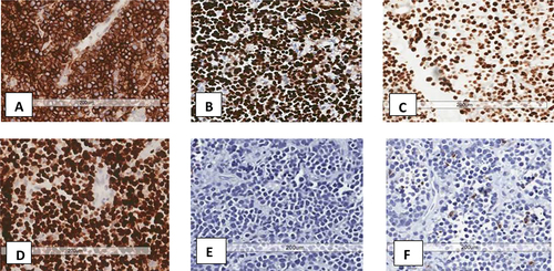 Figure 3 IHC stains showing positive CD45, Pax5, and c-MYC ((A–C) respectively) (x20). (D) shows 100% expression of Ki67. Panels E and F show negative Tdt and CD3 respectively.