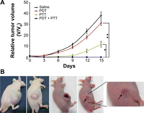 Figure 6 In vivo cancer therapy in HeLa tumor-bearing mice.Notes: (A) Changes in the relative tumor volume (n=3) after different phototherapies. PDT only showed minimal effect on tumor growth, whereas PTT alone showed improved effect on tumor growth. The combination of PDT and PTT showed optimum therapeutic effect compared to PDT only (**P<0.001) or PTT only (*P<0.01). The dual therapy resulted in complete ablation of tumor tissue and no regrowth occurred within a span of 15 days. (B) Photographs of mice with tumors on the 15th day after treatment with saline, PDT only, PTT only, and PDT–PTT combined therapy. The mice with combined therapy showed no sign of tumor regrowth and the burned skin was also healed (the arrow indicates the healed site). P-values were calculated by the Student’s t-test: *P<0.01, **P<0.001. Reprinted from Biomaterials, 34, Sahu A, Choi WI, Lee JH, Tae G, Graphene oxide mediated delivery of methylene blue for combined photodynamic and photothermal therapy, 6239–6248, Copyright ©2013, with permission from Elsevier.Citation24Abbreviations: PDT, photodynamic therapy; PTT, photothermal therapy.