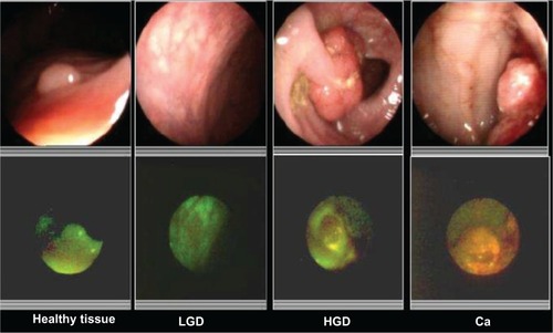 Figure 16 Differentiation of histological stages of malignancy using white light colonoscopy and fluorescence imaging.