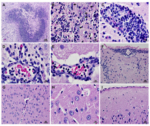 Figure 4 Brain histopathological studies in catheterization rats with Scedosporium apiospermum CBS 11741 infections after 48 h post-inoculation. In uncoated catheter groups, (A) brain abscess was developed without encapsulation. (B–E) The perivascular cuffing mainly with neutrophil infiltrates were found around the site of infection with the presence of S. apiospermum hyphae (as indicated by the arrows in B) and (F) in meninges. (G–I) Unlike the brain without abscess in tryptophol (TOH)-coated catheter groups, absent of necrotic area surrounded with inflammatory cells were noted compared to infected brains. Scale bar = 100, 20, and 10 μm.