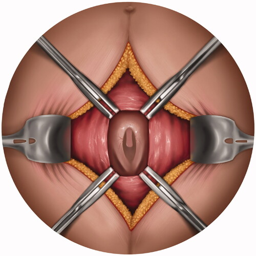 Figure 12. Emily Wallace – Emily Wallace – Open foetal surgery – This illustration shows an incision made on a pregnant person’s abdomen to access a foetus who has spina bifida. The defect on the lower back can now be closed to prevent further damage to the spinal nerves.