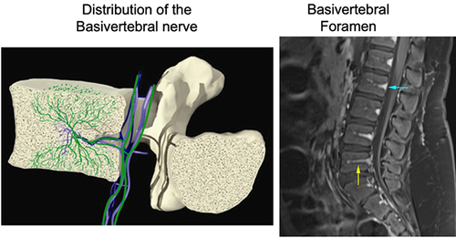 Figure 1 The BVN (white arrows) branches from the SVN as it enters the vertebral body through the central vascular foramen, accompanied by the basivertebral vessels, bifurcating to the endplates. Reprinted with permission from Fischgrund JS, Rhyne A, Franke J, et al. Intraosseous basivertebral nerve ablation for the treatment of chronic low back pain: 2-year results from 415 a prospective randomized double-blind sham-controlled multicenter study. Int J Spine Surg. 2019;13(2):110–119, Copyright © International Society for the Advancement of Spine Surgery 2019. Creative Commons licensing agreement CC BY-NC-ND.Citation3 Reprinted with permission from Traylor K, Murph D. Spinal Vascular Anatomy. The Neurosurgical Atlas. https://www.neurosurgicalatlas.com/volumes/neuroradiology/spinal-corddisorders/spinal-vascular-anatomy.Citation54