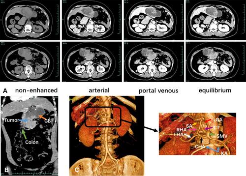 Figure 2 Preoperative CT scan indicated the diagnosis of gallbladder cancer in the SIT setting. (A) The CT images in the non-enhanced, arterial, portal venous, and equilibrium phases. (B) The coronal view showing tumor’s involvement of transverse colon. (C) The CT angiography demonstrating significant vascular abnormalities.