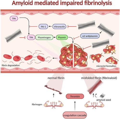 Figure 5. Blood clots formed by thrombin processing of fibrinogen to fibrin recruiting blood platelets in a polymerizing fibrous web. The process of fibrinolysis is regulated by several proteins ultimately affording active plasmin as the proteolytic enzyme to digest insoluble fibrin and, hence resolving the clot. The normal process is shown on the left side of the clot in the figure. If fibrin on the other hand is generated from fibrinogen by thrombin (possibly even without thrombin) in the presence of amyloid seeds the fibrin can form misfolded fibrin (fibrinaloid) which cannot be digested by plasmin (right side of the figure). In addition to seeding misfolding of fibrin, amyloid fibrils are inactivating and activating proteins involved in fibrinolysis: tPA, vitronectin, α2-antiplasmin, and plasmin. Hence, there are many associations between fibrinolysis and amyloid disease as discussed in the main text.