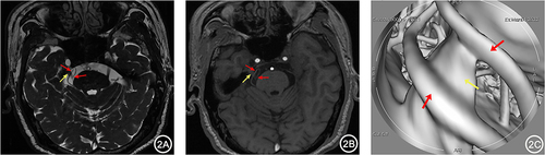 Figure 2 A 66-year-old female with right TN for over 5 years. 3D-FIESTA-c axial (A) and 3D-TOF-MRA axial (B) showed two branches of the right Superior Cerebellar Artery (red arrows) individually compressing the trigeminal nerve (yellow arrows). MRVE image (C) showed the two branches of the right Superior Cerebellar Artery (red arrows) separately compressing the trigeminal nerve from above (yellow arrows).