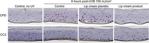Figure S1 Lip cream with UV filters inhibited UVB DNA damage (CPD, pink staining) and apoptosis (CC3, brown staining) in EpiGingival™.Notes: Lip cream with UV filters and without UV filters (placebo) were topically applied 1 hour prior to UVB irradiation (150 mJ/cm2). Non-UVB treatment (untreated) was used as a negative control and baseline. Tissue samples were collected for IHC staining at 6 hours post-UVB (n=3). The images at top panels were scanned at 40× using Nanozoomer (Hamamatsu) and shown at 100%.Abbreviations: CC3, cleaved caspase-3; CPD, cyclobutane pyrimidine dimers; IHC, immunohistochemical; UVB, ultraviolet B.