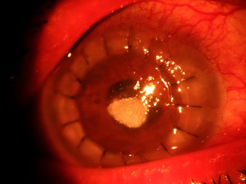 Figure 2 Whitish granular deposition in the central cornea on the 10th postoperative day after penetrating keratoplasty with cataract extraction and posterior chamber intraocular lens implantation.