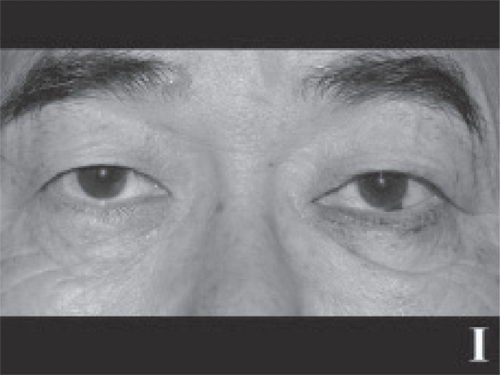 Figure 1 Figure 1A A 3-mm left lower eyelid retraction caused by previous surgery for a squint (inferior rectus muscle recession) is shown.Figure 1B The anterior surface of the lower eyelid retractors is shown. Part of the Lockwood ligament can be seen.Figure 1C The posterior surface of the lower eyelid retractors is shown. The double layers of the retractors can be clearly discerned. The posterior layer of the lower eyelid retractors is always shorter than the anterior layer.Figure 1D The lateral and medial horns of the lower eyelid retractors are incised at the width of 17 mm.Figure 1E The harvested auricular cartilage is interposed between the lower edge of the tarsus and the distal edge of the anterior layer of the lower eyelid retractors while the posterior layer remains unfixed to any structure. The volume of the harvested cartilage for the retraction patients is twice the retraction from the lower corneal limbus with 1 mm of extra volume in the proximal and distal margins, respectively, for sutures. The height of the harvested cartilage for the entropion patients is 4 mm (horizontal length in both groups is always constant at 17 mm).Figure 1F The cartilage is fixed with 5 sutures on each of the distal and proximal sides. The suture on the right upper edge is masked by the recessed anterior layer of the lower eyelid retractors in this image.Figure 1G Sufficient elevation of the lower eyelid is shown. The skin is sutured with interrupted 6–0 nylon sutures.Figure 1H The rehabilitated left lower eyelid moves down sufficiently during a downward gaze.Figure 1I The contour of the left lower eyelid is within the permissible range.