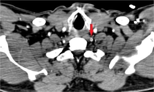 Figure 2 An axial view of computed tomography angiography scan showing a donut sign in the left vertebral artery, suggestive of free-floating thrombus at the level of V1.