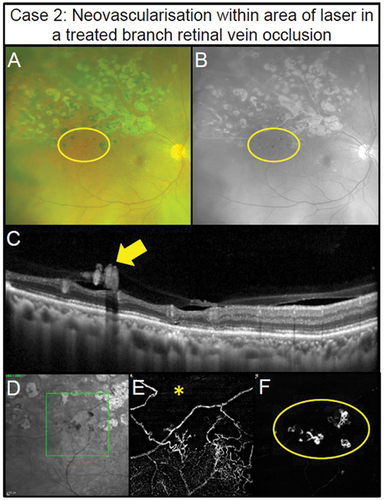 Figure 3. Pre-retinal neovascularisation associated with a longstanding superior branch retinal vein occlusion treated with retinal photocoagulation laser in a 65-year-old male (Case 2). (A) Subtle pre-retinal neovascularisation located between regions of laser (oval) with ultra-widefield imaging. (B) Green separation channel highlights the region of neovascularisation. (C) OCT line scans through the region of neovascularisation shows pre-retinal abnormal hyper-reflective tissue along the posterior interface (arrow). (D) Scanning laser ophthalmoscope image of the OCT-A scan location (rectangle). (E) Retinal nonperfusion suggestive of retinal ischaemia present superiorly (asterisk) with 3 × 3 mm OCT-A image of the deep capillary plexus (defined as posterior inner plexiform layer to posterior outer plexiform layer). Impaired retinal perfusion is also present in the inferior aspects of the scan. (F) Pre-retinal neovascularisation (oval) in the region of non-perfusion noted in the previous panel detected using 3 × 3 mm OCT-A imaging of the vitreoretinal interface (defined as user-defined anterior border set in the vitreous space to the inner limiting membrane).