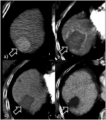 Figure 1. Short course, large volume RF ablation with long term favorable outcome. (a) A 2.2 cm HCC at S8 (arrow) was ablated with a single insertion of a 4 cm exposed tip RF electrode in 6 min with 2000 mA current. (b) At 24-h, CT the dimensions of the necrosis volume achieved were 4.8 × 4.3 × 5.5 cm. At 2- (c) and 4-year (d) follow-up, ablation was complete with no LTP.