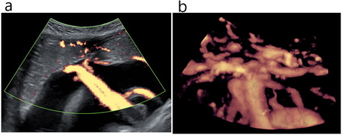 Figure 1. 3D-PDU image of the foetal placenta in the isolated single umbilical artery (ISUA) group and control group; (a, b) 3D-PDU blood flow images at the insertion point of umbilical cord and placenta in the ISUA group showing a 3D vascular tree structure.