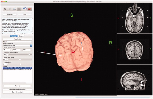 Figure 5. Users can maximize and interact with a surface view of the extracted brain, allowing them to visualize trajectories as they penetrate the brain. Modifications to the lead trajectories can be made in order to avoid cortical sulci or vessels.