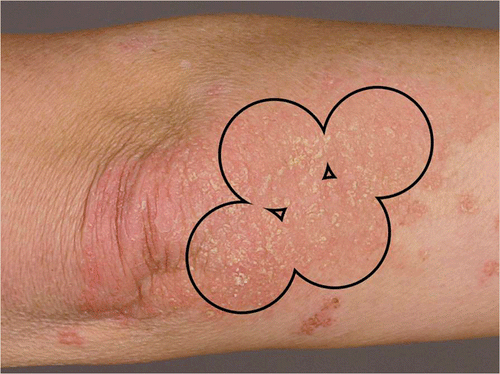 Figure 1 Treated areas: ointment was applied to the whole lesion, whereas the excimer laser was placed only in the distal half of the lesions.
