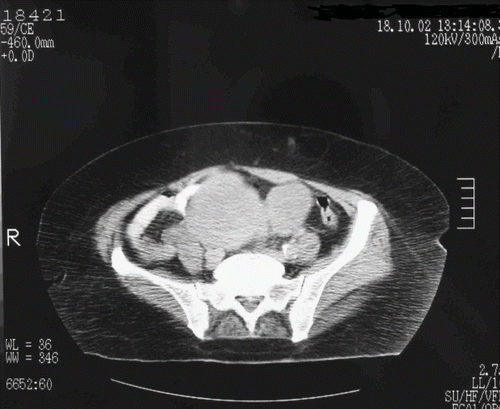 Figure 1 Computed tomography revealing extended desmoid tumors in the abdominal cavity.