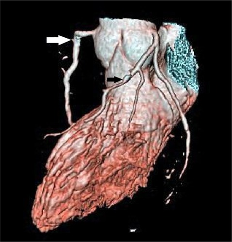 Figure 1 Right coronary artery with plaque (white arrow) and left anterior descending coronary artery with plaque (black arrow).