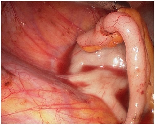 Figure 1 Endometriosis involving the appendix.
