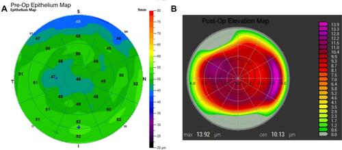 Figure 2 (A) Pre-op pachymetry showing corneal thickness.(B) Pre-op epithelium map. – 9 mm ETM (Avanti XR).