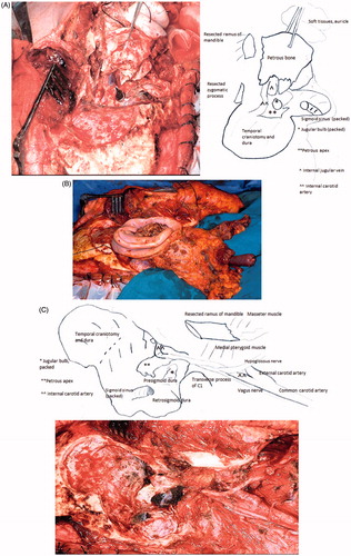 Figure 2. Right STBR in T4 tumor (surgical picture). (A) View from the vertex: the resected block of petrous bone is displaced inferiorly. The dura of the temporal and occipital craniotomies form the boundary of the approach. (B) Lateral view: neck dissection lies in continuity with the petrous bone block. (C) Lateral view: the surgical field after removal of the specimen. The internal carotid artery and petrous apex represent the medial boundary of resection.