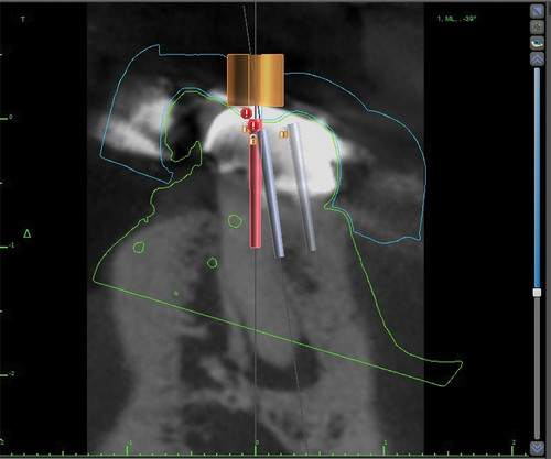 Figure 34. Endo guide planning in BSP tangential view.
