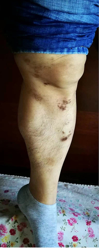 Figure 4 Pigmentation and depression in the sacroiliac and lower limbs.
