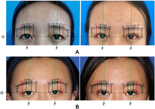 Figure 3 (A and B) both show the changes in the eyebrow shape before and after surgery. Before the operation (Left). Three months after external incision upper eyelidplasty (Right). The indicators of H1~H6 are shown in Table 1.