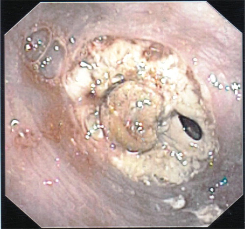 Fig. 2 EGD showing complete obstruction with entrapped band and surrounding necrosis.