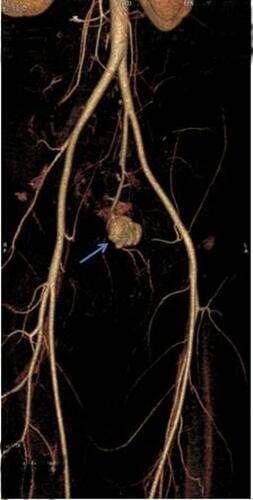 Figure 3 CT scan reconstruction showing pseudoaneurysm of the inferior gluteal artery (blue arrow).