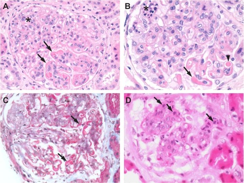 Figure 9 Class IV lupus nephritis. (A) Mesangial hypercellularity (asterisk) and deposits (arrows) associated with the capillary loops seen in a hematoxylin and eosin-stained section. (B) Foci of necrosis (asterisk), capillary loop deposits (arrow), and vascular thrombi (arrow head) are also seen. (C) Fuchsinophilic deposits (arrows) appear clearer in a Masson’s trichrome-stained section. (D) Hematoxylin bodies (arrows) appearing as darkly stained nuclei that blend into the background.