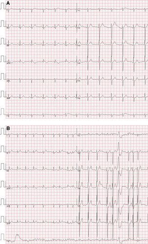 Figure 1 (A) Electrocardiogram findings before vaccination of SARS-CoV-2. (B) Electrocardiogram findings after vaccination of SARS-CoV-2.