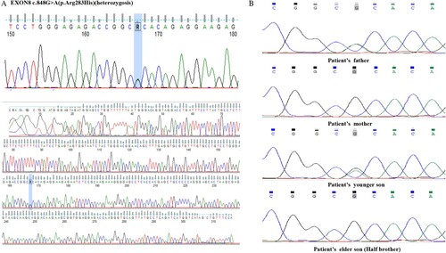 Figure 2. Sanger sequencing peaks of TP53 c.848G>A (p.Arg283His) mutation detection in the patient (A) and her relatives (B).