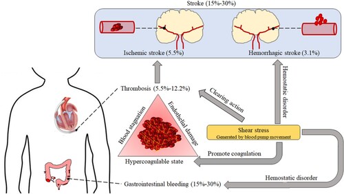 Figure 2. Clinical incidence and relationship between thrombosis, bleeding (gastrointestinal bleeding and hemorrhagic stroke), and ischemic stroke in the blood pump.