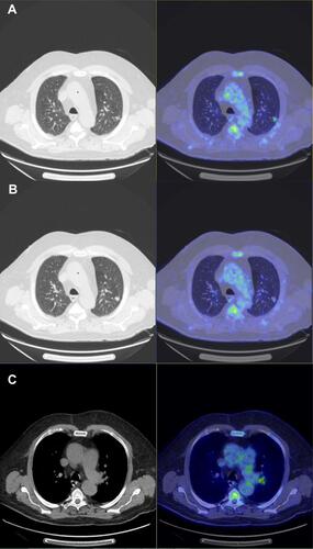 Figure 2 Pre-therapeutic TEP scan of March 19, 2019 representing a hypermetabolism of the left upper lobe pulmonary nodule (SUVmax: 3.29) (A and B); and an intense hypermetabolism focus in the left interlobular lymph node (SUVmax: 5.55) (C).