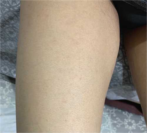 Figure 2 Positive DFX challenge: a few discrete ill-defined erythematous macules on the right arm.