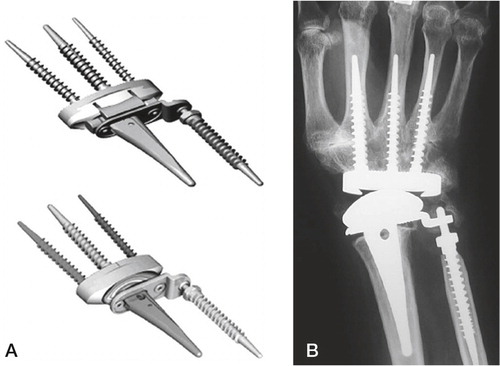 Figure 17. The total modular wrist system (TMW). A) The constrained version (upper), the unconstrained version (lower). B) Implant in situ. (Courtesy of Dr Hubach and OrthoCube.)
