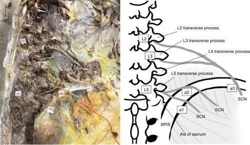 Figure 2 Photographs and the corresponding illustration showing three branches of the SCN on the right side of a cadaveric specimen obtained from an 89-year-old man (specimen no. 22). The L5 nerve roots had a dorsal branch ramifying into the most medial SCN branch (a1) and the second most medial branch (a2). The lateral branch of the SCN (a3) had separate origins from the L2 and L3 nerve roots.