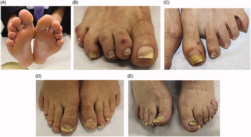 Figure 3. Clinical examination findings in onychomycosis. (A) Tinea pedis, scale on the plantar feet and web spaces. (B) Subungual hyperkeratosis and onycholysis of the right great toenail. (C) Yellow discolouration and onycholysis of the left great toenail. (D) Subungual hyperkeratosis and onycholysis in multiple toenails. (E) Severe onychodystrophy in multiple toenails. (DOI: 10.1016/j.jaad.2018.03.062, Permission for reuse of these images has been obtained from the copyright holder (Elsevier) and applies to publications with the Creative Commons license).
