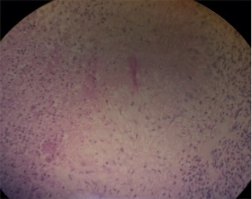Figure 2 Liver biopsy shows numerous epithelioid granulomas, giant cells, necrosis, and microabscesses and with chronic inflammatory cells, mainly lymphocytes and eosinophils.