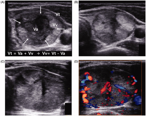 Figure 1. (A) Transverse image from a 29-year-old woman who received RFA for a benign thyroid nodule 4 months previously. The index nodule volume was 21.1 mL. At the centre of the nodule, the ablated area was seen as a hypoechoic area (Va, arrows). At the margin of the nodule, the incompletely treated viable portion showed an isoechoic area (Vv). The volumes at 4 months were Vt = 7.4 mL, Va = 2.1 mL and Vv = 5.3 mL. (B) Transverse image at the 7-month follow-up. The Vt decreased to 5.3 mL whereas the Vv increased to 5.2 mL. (C) Transverse image at the 21-month follow-up. The Va decreased and nearly disappeared. The Vt increased to 12.4 mL through an increase in the Vv (12.3 mL). (D) Colour Doppler US image showing increased vascularity in the viable area of the nodule.