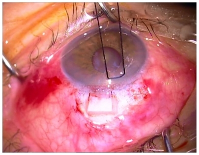 Figure 2 4 × 4 mm piece of sponge soaked in mitomycin C (0.1 mg/mL or 0.2 mg/mL) under dissected scleral flap.