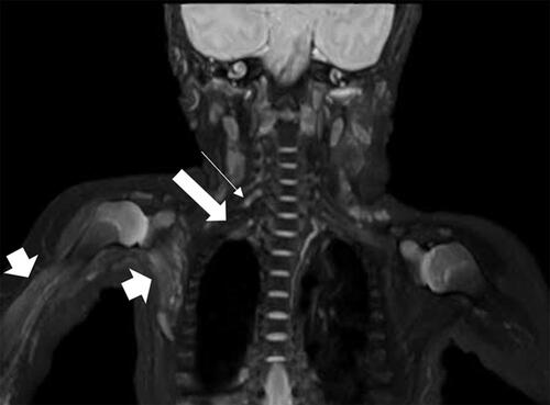 Figure 2 M, 34 days, right upper limb weakness for 1 month. Muscle strength was graded 0. EMG showed neurogenic damage to the right brachial plexus. Coronal 3D-STIR-SPACE image displayed thickening of the right nerve root at C5 and C6 level (thin arrow), right nerve root dissection at C7 and C8 level (thick arrow), and increased signal of right shoulder and upper limb muscles (arrowhead).