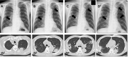Figure 1 Chest radiography and computed tomography images. (A, B, and C) were obtained six, four, and one month(s) before admission, respectively (black arrow indicates interstitial infiltration); (D1) multiple ground-glass opacities on admission; (D2–5) multiple nodular lesions with cavities on both lung fields on admission.