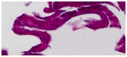 Figure 2 Hematoxylin and eosin stain of epithelial growth removed from the type 1 Boston Keratoprosthesis optic surface showing a variable thickness and number of cell layers, no vascular structures, no goblet cells, and no basement membrane.