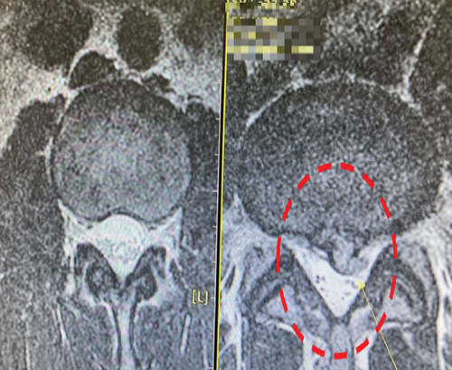 Figure 2. MRI of an ordinary person’s spine (2a: left) and that of Athlete 1 (2b: right).