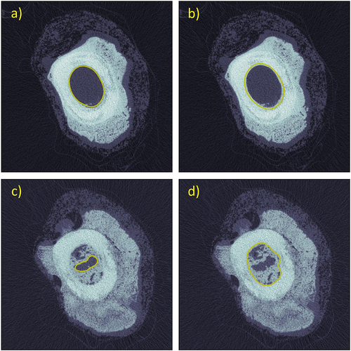 Figure 7. Successful detection of endocortical boundaries in different slice images within one operated limb required adaptive endocortical thresholding (τendo). a/b) for a slice located ~11 mm distal to the osteotomy centre with no endosteal callus, the endocortical boundary was properly detected with τendo = 4,250, but improperly detected with τendo = 6,650 (correct threshold in d). c/d) for a slice located 4 mm proximal to the osteotomy centre with endosteal callus, the endocortical boundary was incorrectly detected with τendo = 4,250 (correct threshold in a), but properly detected with τendo = 6,650.
