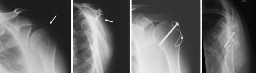 Figure 3. Patient no. 6 (Table 3) before and after open reduction and internal fixation of greater tuberosity fragments with major displacement (white arrows). The multiple fragments were fixed with a screw and a tension wire.