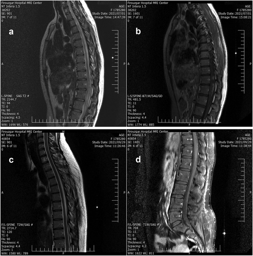 Figure 1. (a), (b) MRI reveals longitudinally extensive transverse myelitis from T10 to L1 with cord swelling and patchy/nodular enhancement, T2 and T1 with contrast, respectively; (c), (d) which turned to normal within 3 months followup, T2 and T1 with contrast, respectively.